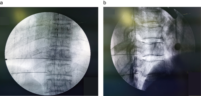 A central and peripheral dual neuromodulation strategy in pain management of zoster-associated pain