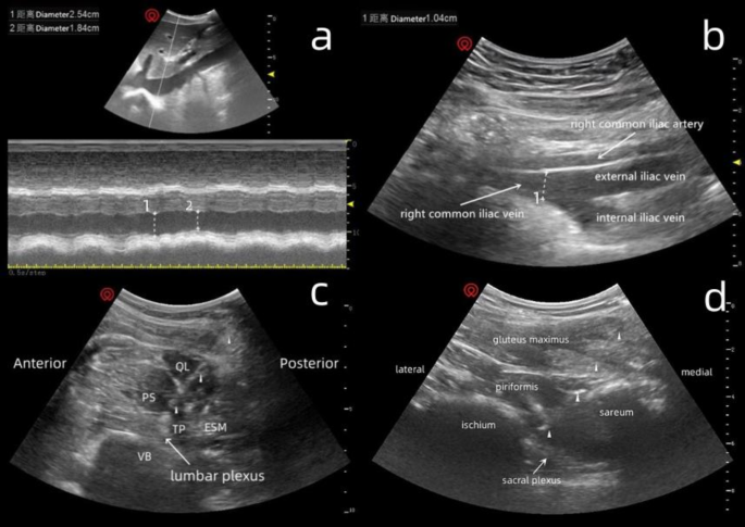 Ivc Table Efficacy of the inferior vena cava collapsibility index in predicting ...
