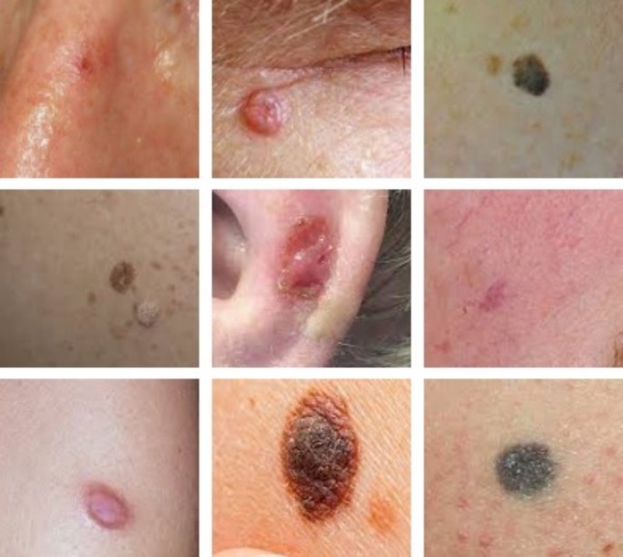 melanotan nässpray Melanoma vs Benign Melanocytic Nevus