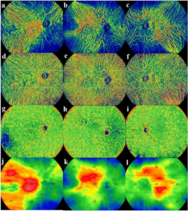 Quantitative analysis of choroidal vascular structures and anatomical ...