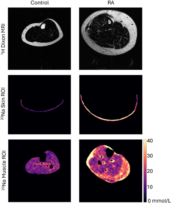 Tissue sodium in patients with rheumatoid arthritis: a novel potential ...