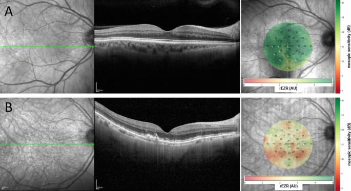 Ellipsoid zone reflectivity as a functional imaging biomarker for age-related macular degeneration: a MACUSTAR study report