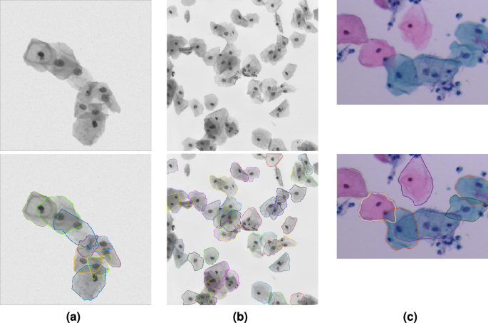 Optimized segmentation of overlapping cervical cells based on ...