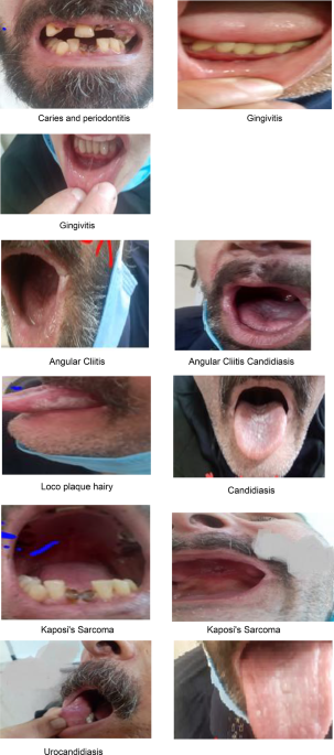 A cross-sectional study of oral health and disease prevalence in HIV-positive patients in Tabriz, Iran (2024)