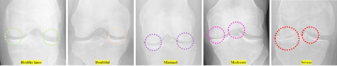 Lightweight early detection of knee osteoarthritis in athletes