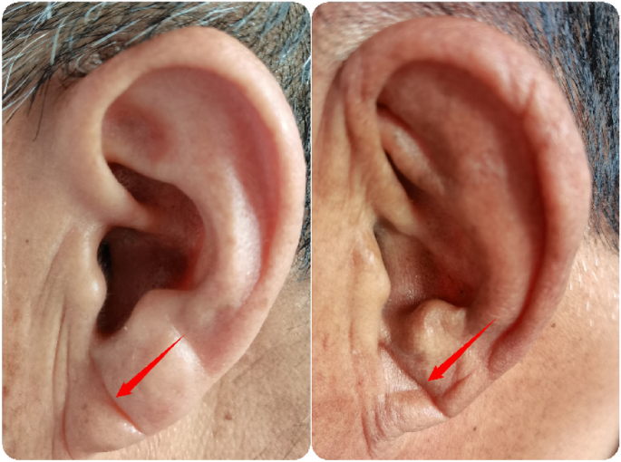 Diagnostic value of the diagonal earlobe crease in combination with  lipoprotein(a) in coronary heart disease | Scientific Reports