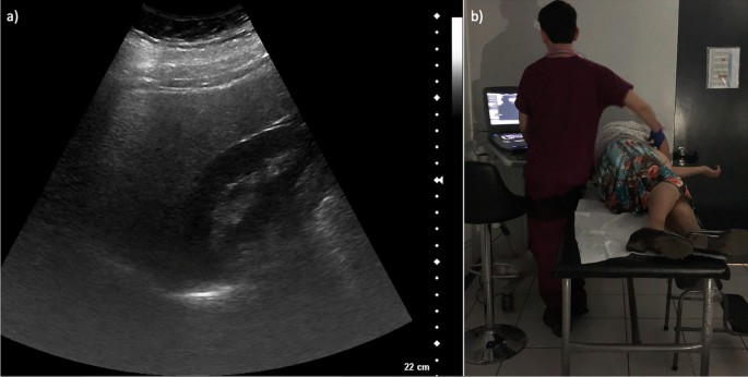 Inter- and intra-observer agreement in ultrasound diagnosis of steatotic liver disease: implications for screening in resource-limited settings