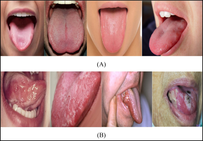Enhanced Deep Learning for Early Oral Cancer Detection Using a 19-Layer CNN on Lip and Tongue Images