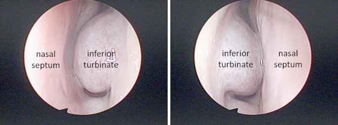Revolutionizing Allergic Rhinitis Diagnosis with Deep Learning and Nasal Endoscopy Images