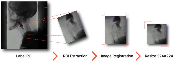Automated Detection of Penetration and Aspiration in Swallowing Studies Using Deep Learning Video Analysis