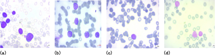 Early Detection of Acute Lymphoblastic Leukemia Using Deep Learning on Microscopic Images