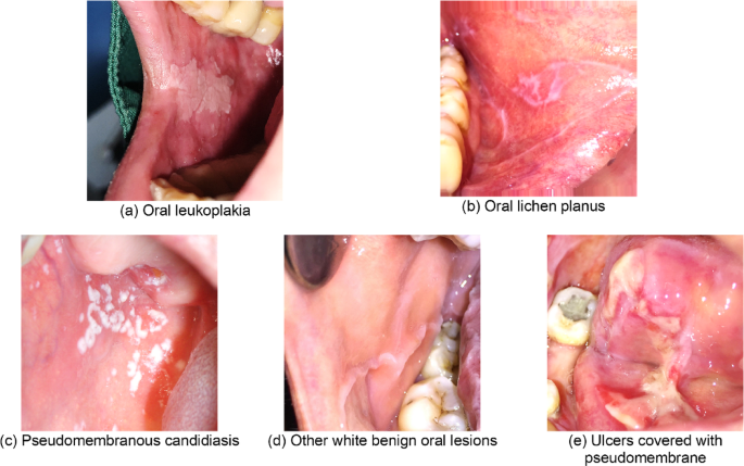 Deep Learning Insights: Classifying and Detecting Oral White Lesions in Photographic Images