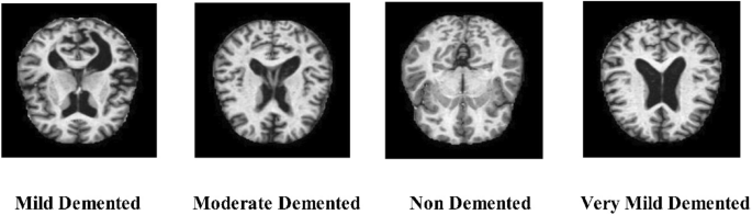 Revolutionary Deep Learning Network for Predicting Alzheimer’s Disease Using Inverted Self-Attention and Vision Transformers