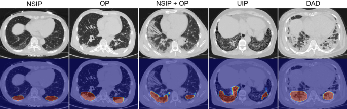 Classifying Imaging Patterns of Interstitial Lung Disease in Idiopathic Inflammatory Myopathies Using Deep Learning