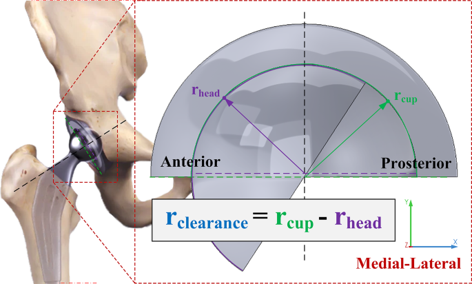Influence of radial clearance on Tresca stress in Al2O2-on-Al2O3 ...