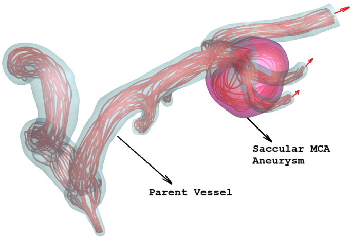 Enhancing Blood Flow Prediction in Cerebral Aneurysms with Machine Learning and Proper Orthogonal Decomposition