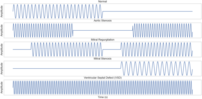 Explainable attention-based deep learning for classification and interpretation of heart murmurs using phonocardiograms