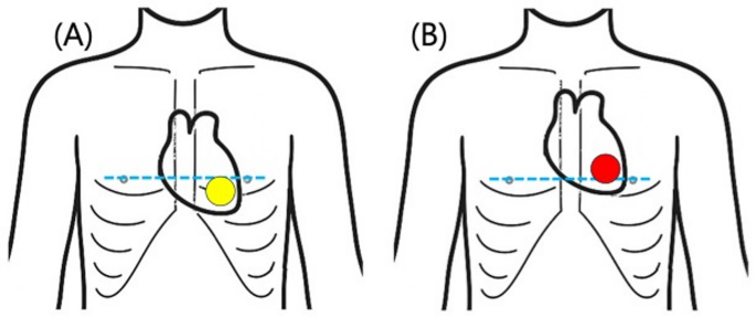 Reassessing chest compression sites in pediatric cardiopulmonary ...