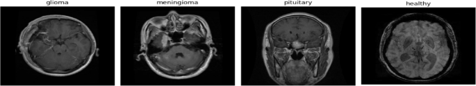 A swarm intelligence-driven hybrid framework for brain tumor classification with enhanced deep features