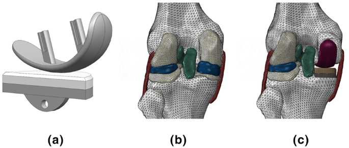 Pf Malalignment Biomechanical analysis of femoral component malalignment in medial ...