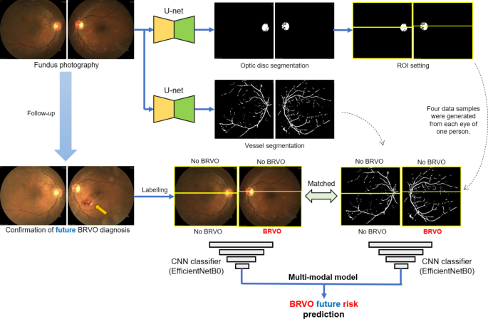 Predicting branch retinal vein occlusion development using multimodal ...