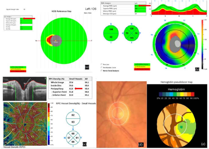 Structural and vascular assessment of the optic nerve head and macula ...