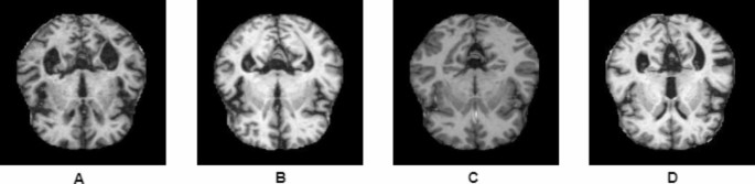 A fine-tuned convolutional neural network model for accurate alzheimer’s disease classification
