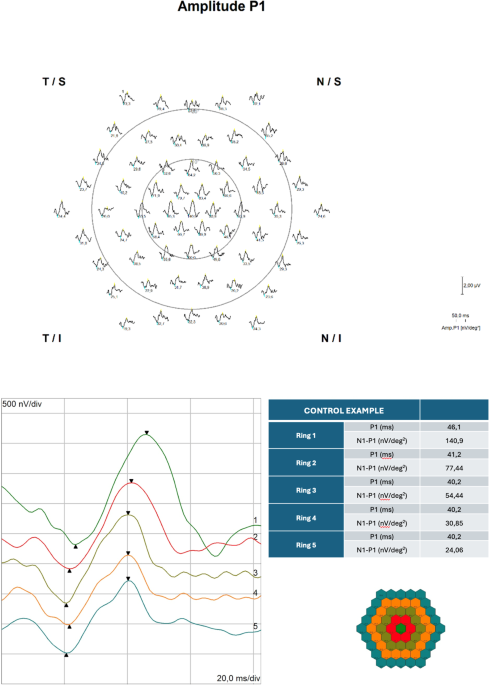 Early detection of retinal dysfunction in type 1 diabetes without ...