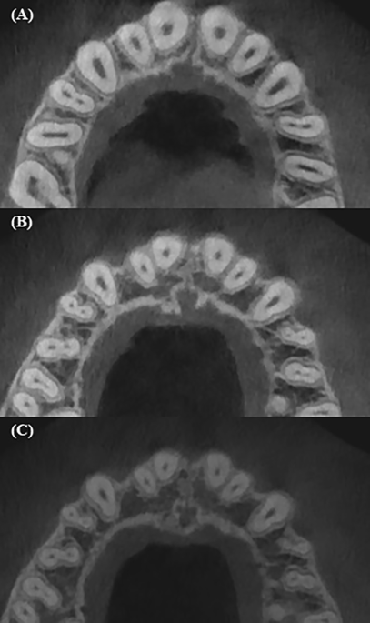 Ledge Rct Evaluation the root canal shape among residents of Moscow region using ...