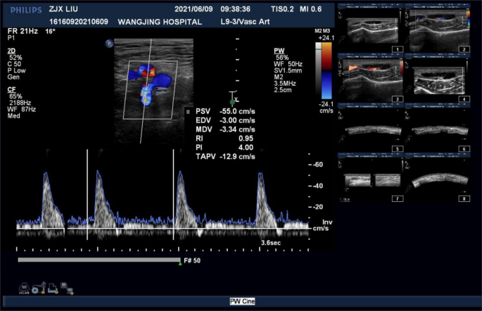 Clinical evaluation of blood flow in femoral head necrosis using color ...