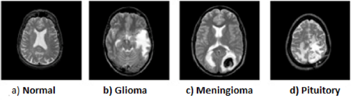 Brain tumor detection empowered with ensemble deep learning approaches from MRI scan images Brain tumor detection empowered with ensemble deep learning approaches from MRI scan images