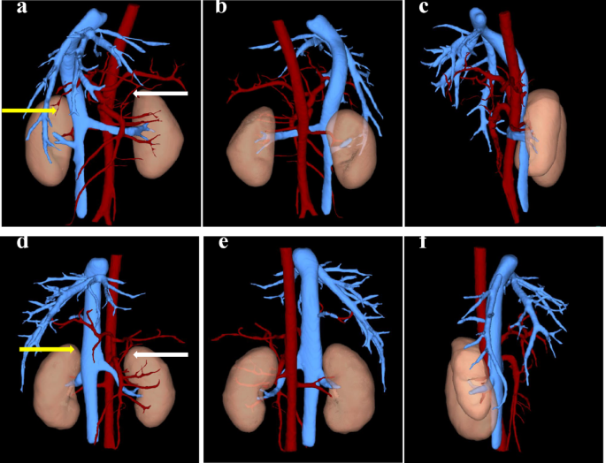 Kidney volume measurement and predictive modeling in children aged 0–18 years using a computer-assisted surgery system
