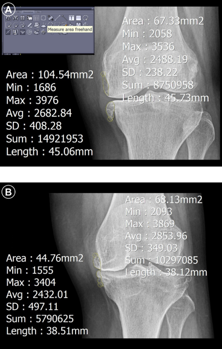 clinical study b12 injection osteophyte Correlation of inflammatory mediators with formation in end-stage knee osteoarthritis Do B12 Injections Help