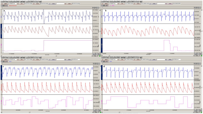 glutathione reddit nootropics Evaluation of vinpocetine in an acute doxorubicin-induced cardiotoxicity model in rats Daily Essentials