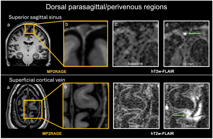 Early post-contrast signal changes in CSF spaces and CSF outflow-related regions on 7 Tesla MRI