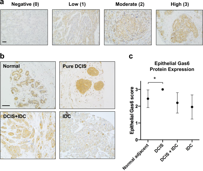 Gas6 expression is reduced in advanced breast cancers