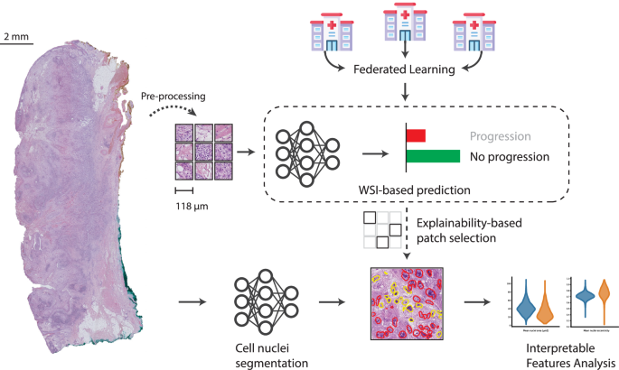 Predicting Disease Progression Risk in Cutaneous Squamous Cell Carcinoma with Explainable Federated Deep Learning