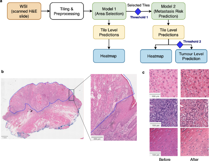 Predicting Metastasis Risk in Cutaneous Squamous Cell Carcinoma with Deep Learning and Histopathology Insights