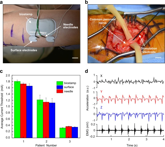 Intraoperative monitoring of neuromuscular function with soft, skin-mounted  wireless devices | npj Digital Medicine