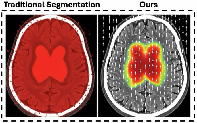Modeling Ischemic Stroke Pathological Dynamics via Continuous Fields and Vector Flow - npj Digital Medicine