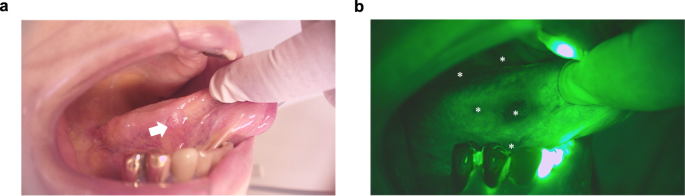 Flavinated SDHA underlies the change in intrinsic optical properties of  oral cancers
