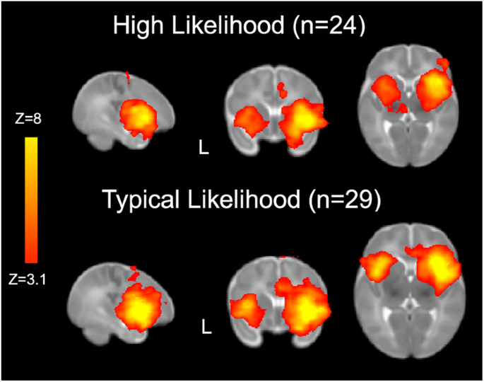 Salience network connectivity is altered in 6-week-old infants at heightened likelihood for developing autism
