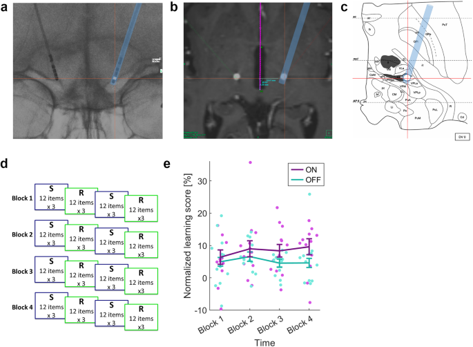 Ventrointermediate thalamic stimulation improves motor learning in 