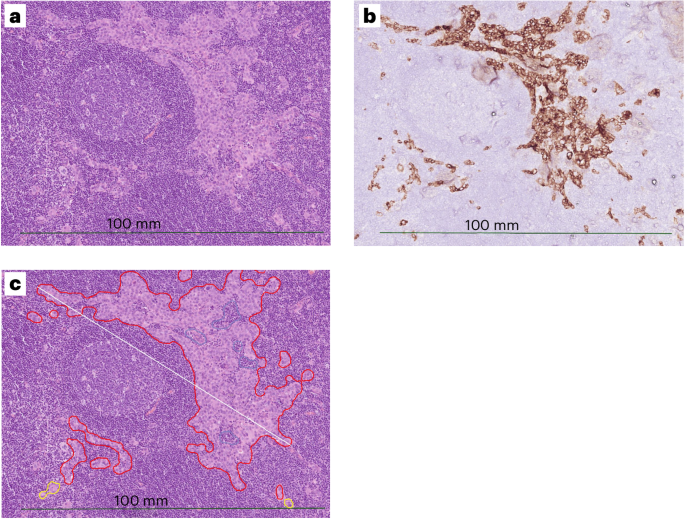 Ai-assisted detection of lymph node metastases safely reduces costs and time