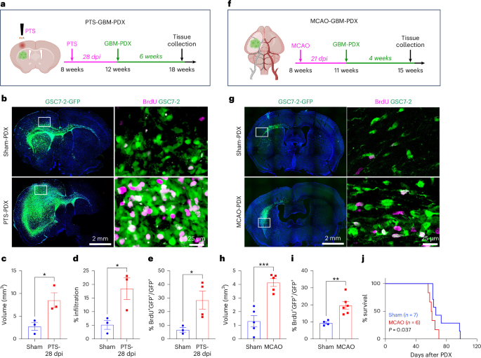 Stroke drives glioma progression through the emergence of tumor-associated astrocytes with reduced Ca2+ activity
