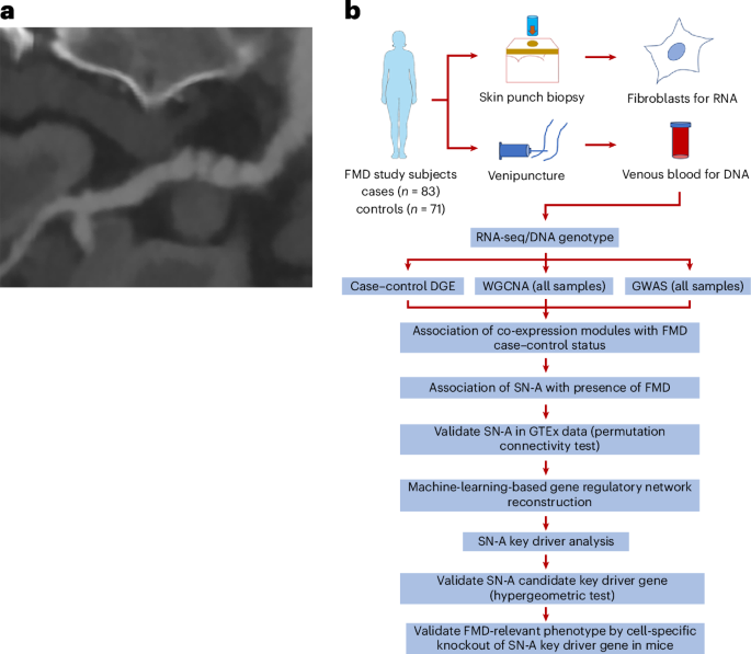 Identifying a gene-regulatory network that drives fibromuscular dysplasia