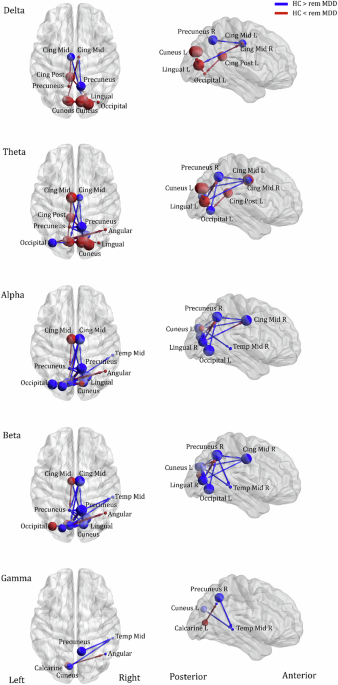 EEG-based brain connectivity and sentiment analysis from smartphone social  communication: insights into remitted major depressive disorder among  adolescents | NPP—Digital Psychiatry and Neuroscience