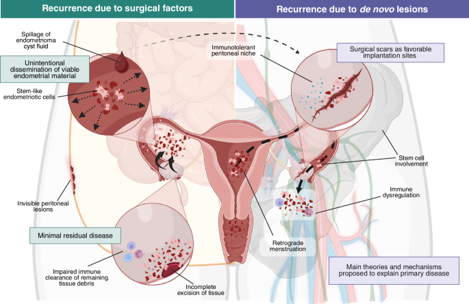 Rethinking endometriosis recurrence: from clinical challenge to biological opportunity - npj Women's Health