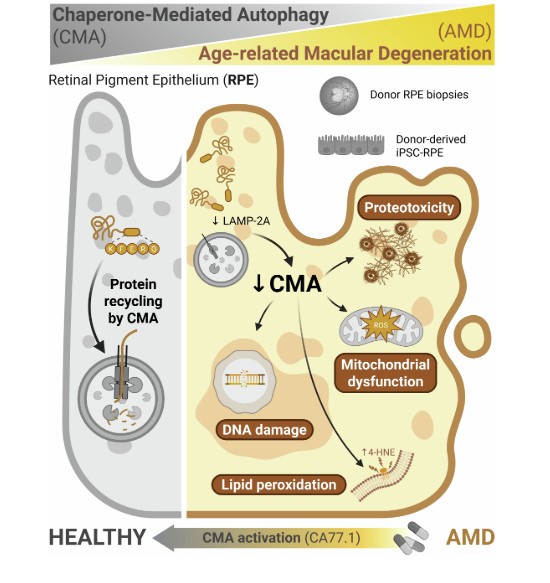 Defective chaperone-mediated autophagy in the retinal pigment epithelium of age-related macular degeneration patients | EMBO Molecular Medicine
