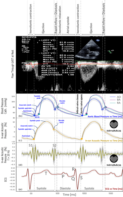 Non-invasive blood pressure monitoring with in-ear infrasonic hemodynography for preventative cardiovascular care